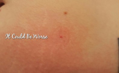 Humira Wednesday #4