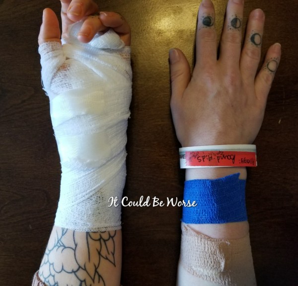 Lumpy, the Ganglion Cyst, A Trilogy - It Could Be Worse - Mary Horsley