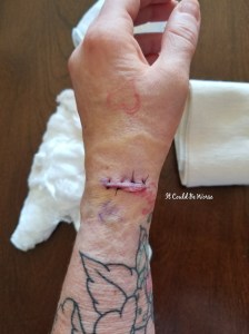 Lumpy, the Ganglion Cyst, A Trilogy - It Could Be Worse - Mary Horsley
