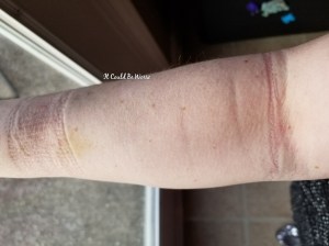 Stelara Infusion & Ganglionectomy Pain - It Could Be Worse - Mary Horsley