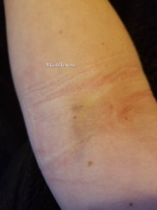 Stelara Infusion & Ganglionectomy Pain - It Could Be Worse - Mary Horsley