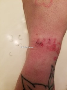 February - It Could Be Worse Blog- Mary Horsley - Ganglionectomy stitches