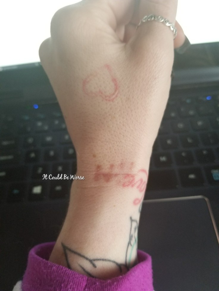 February - It Could Be Worse Blog- Mary Horsley - ganglion cyst surgery scar