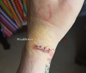 My Ganglion Cyst - The Tetralogy | IT COULD BE WORSE BLOG