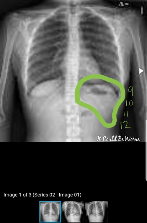 Stelara Self-Injection #2 & Rib Pain - It Could Be Worse Blog - Mary Horsley