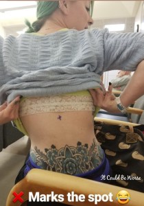 My Wonky Ribs and Neurectomy | IT COULD BE WORSE BLOG