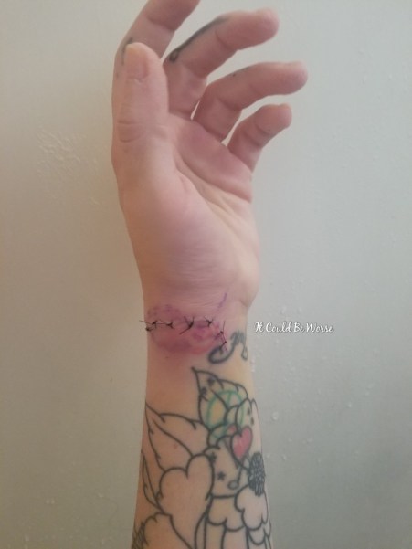 My Ganglion Cyst - The Tetralogy | IT COULD BE WORSE BLOG