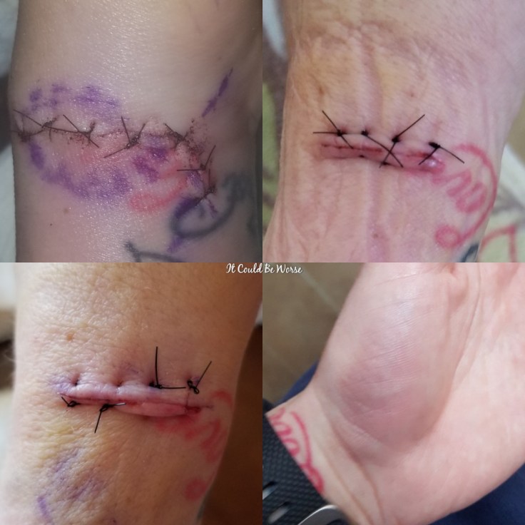 De Quervain's Tenosynovitis - Lefty | IT COULD BE WORSE BLOG