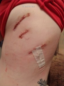My Wonky Ribs and Neurectomy | IT COULD BE WORSE BLOG