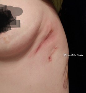 My Wonky Ribs and Neurectomy | IT COULD BE WORSE BLOG