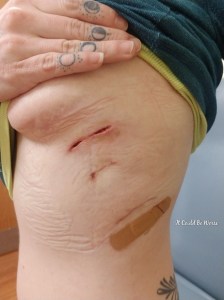 My Wonky Ribs and Neurectomy | IT COULD BE WORSE BLOG