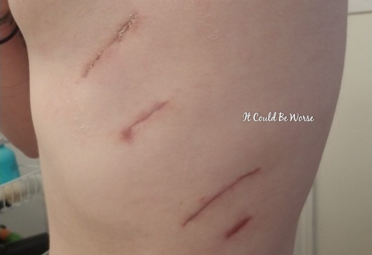 My Wonky Ribs and Neurectomy | IT COULD BE WORSE BLOG