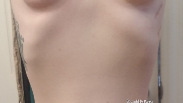 My Wonky Ribs and Neurectomy | IT COULD BE WORSE BLOG