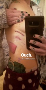 My Wonky Ribs and Neurectomy | IT COULD BE WORSE BLOG