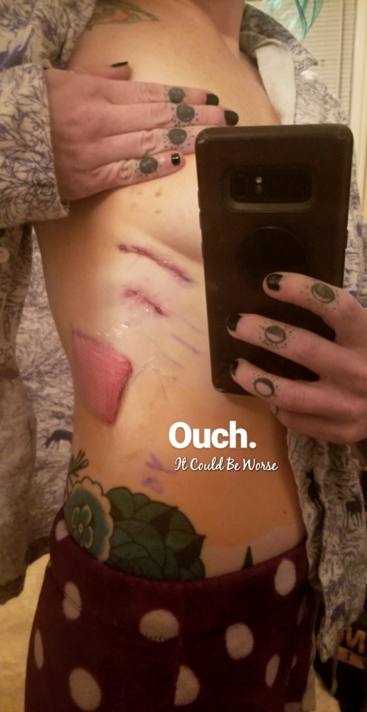 My Wonky Ribs and Neurectomy | IT COULD BE WORSE BLOG