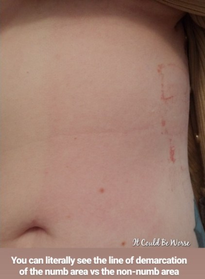 My Wonky Ribs and Neurectomy | IT COULD BE WORSE BLOG