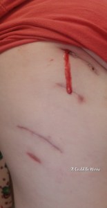 My Wonky Ribs and Neurectomy | IT COULD BE WORSE BLOG