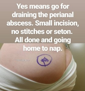 Perianal Abscess #2 in My Crohn's Disease Journey | IT COULD BE WORSE BLOG - Mary Horsley