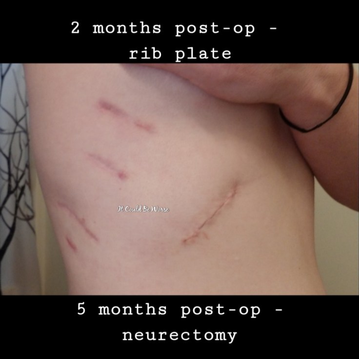 Rib Plating Surgery and Thoracic Appointments | IT COULD BE WORSE BLOG