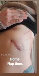 Rib Plating Surgery and Thoracic Appointments | IT COULD BE WORSE BLOG