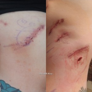 Rib Plating Surgery and Thoracic Appointments | IT COULD BE WORSE BLOG