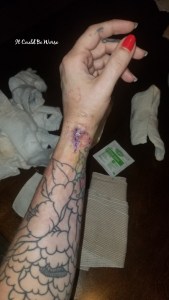De Quervain's Tenosynovitis - Lefty | IT COULD BE WORSE BLOG