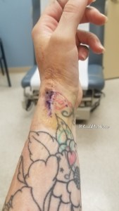 De Quervain's Tenosynovitis - Lefty | IT COULD BE WORSE BLOG