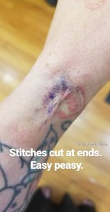 De Quervain's Tenosynovitis - Lefty | IT COULD BE WORSE BLOG