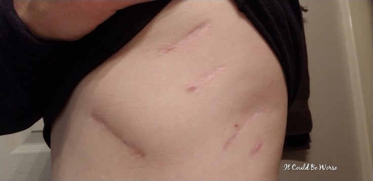 Thoracic Follow-Up & Slipping Rib Syndrome | IT COULD BE WORSE BLOG