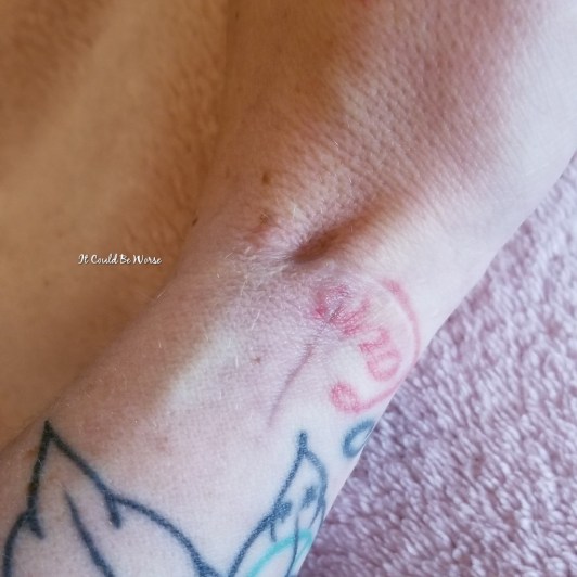 De Quervain's Tenosynovitis - Lefty | IT COULD BE WORSE BLOG