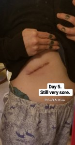 Slipping Rib Syndrome | IT COULD BE WORSE BLOG