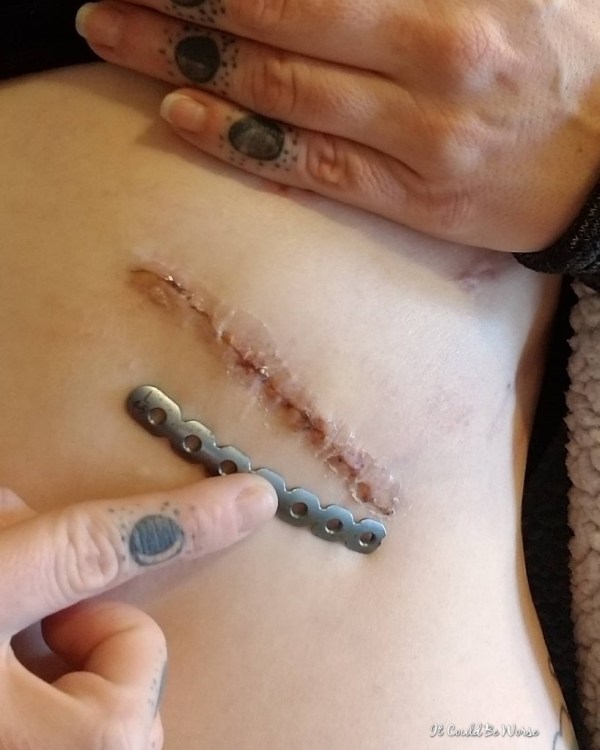 Slipping Rib Syndrome | IT COULD BE WORSE BLOG
