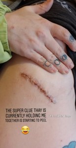Slipping Rib Syndrome | IT COULD BE WORSE BLOG