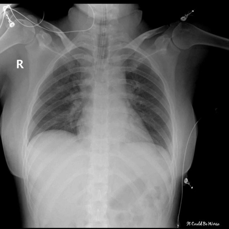 Slipping Rib Syndrome | IT COULD BE WORSE BLOG