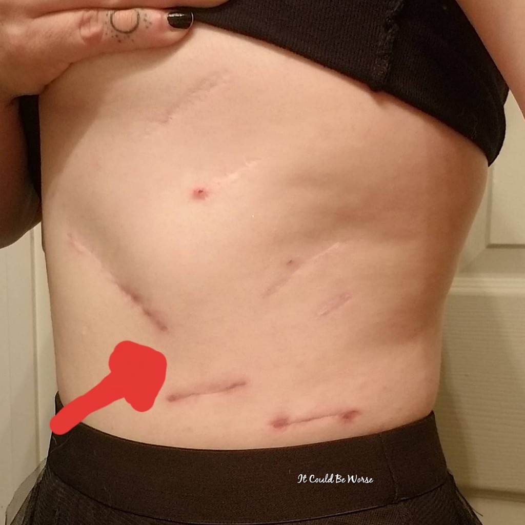 Slipping Rib Syndrome - Ribs Not Healing & WV Consult Scheduled