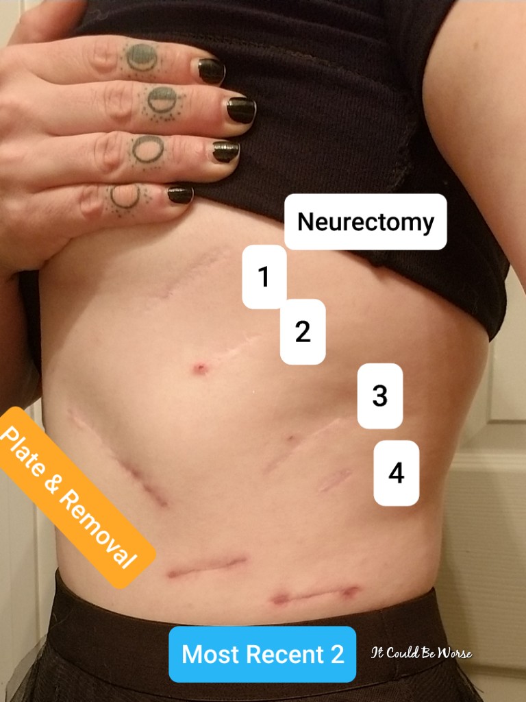 3 Years & 5 Surgeries- Slipping Rib Syndrome