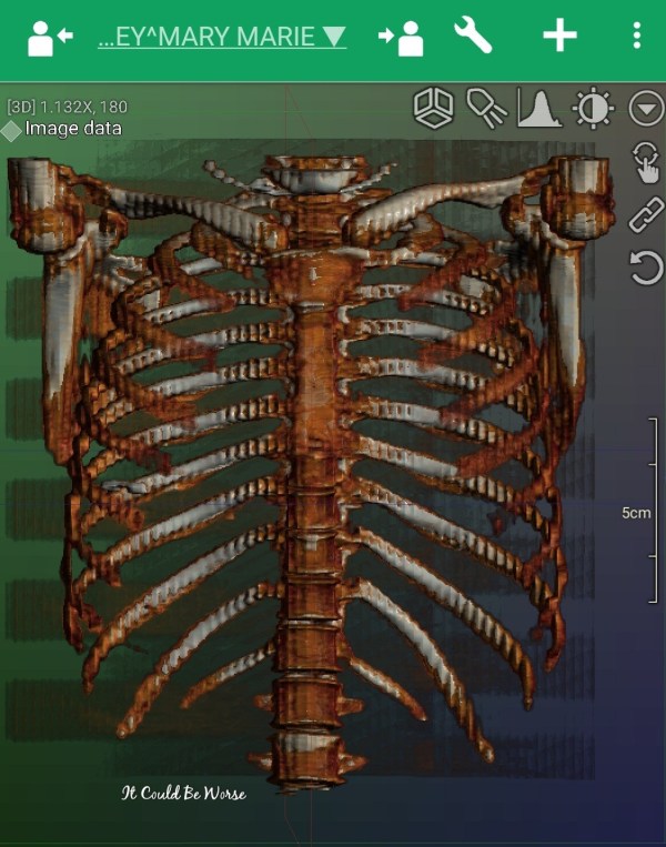 3 Years & 5 Surgeries- Slipping Rib Syndrome