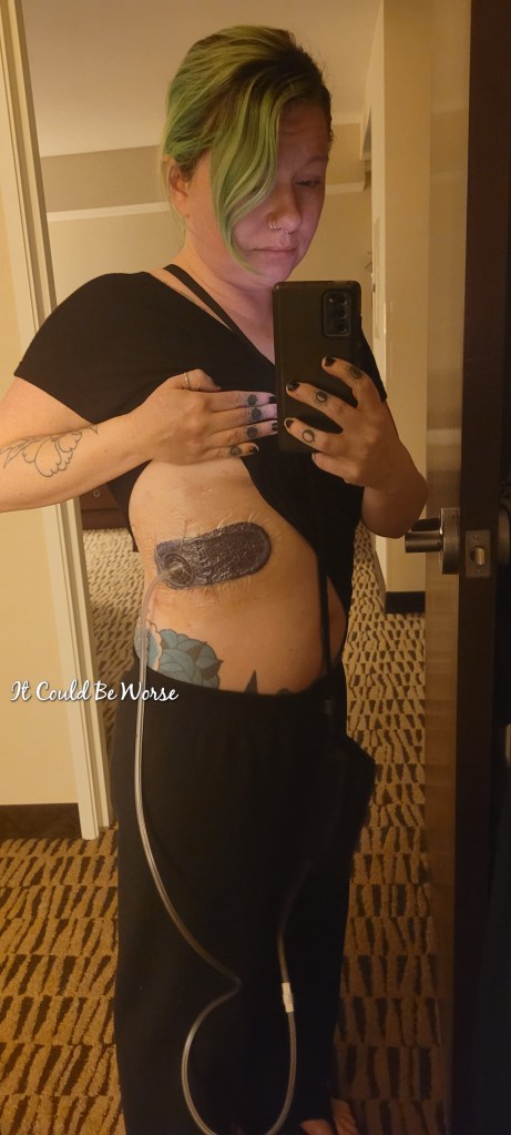 Slipping Rib Syndrome - Hansen Technique & One Month Follow-Up