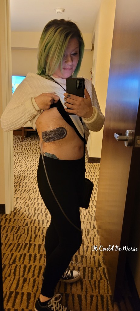 Slipping Rib Syndrome - Hansen Technique & One Month Follow-Up