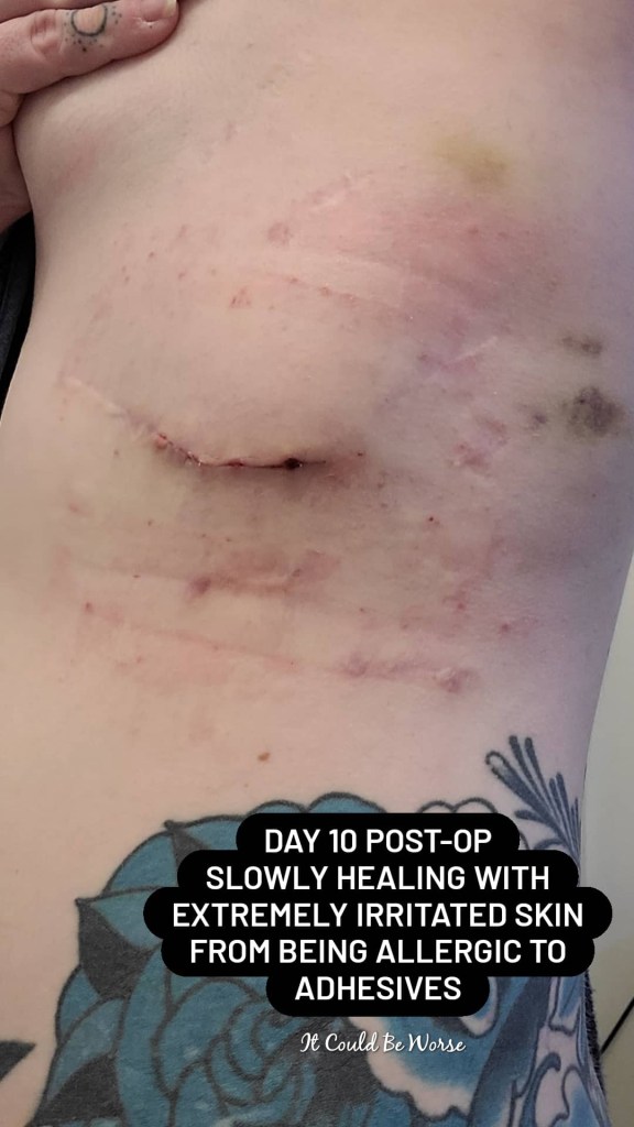 Slipping Rib Syndrome - Hansen Technique & One Month Follow-Up