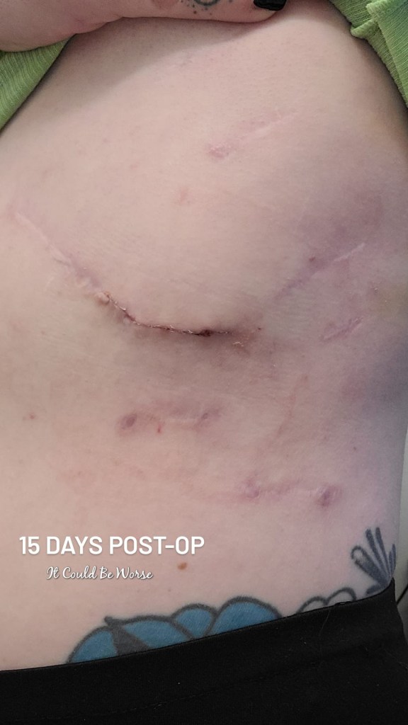 Slipping Rib Syndrome - Hansen Technique & One Month Follow-Up