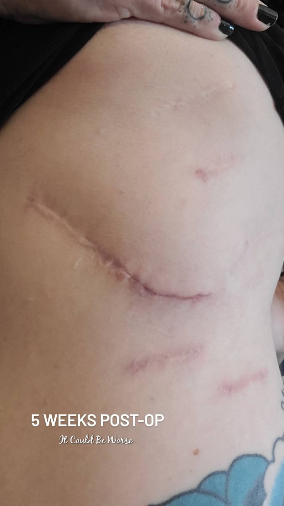 Slipping Rib Syndrome - Hansen Technique & One Month Follow-Up