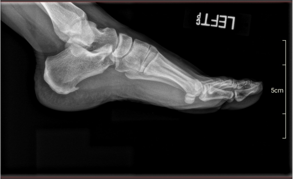 Pain in the Neck - It Could Be Worse Blog - Heel Spur - X-ray - Mary Horsley