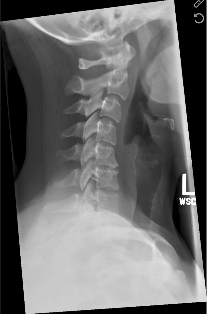 Pain in the Neck - It Could Be Worse Blog - Degenerative Disc Disease - X-ray