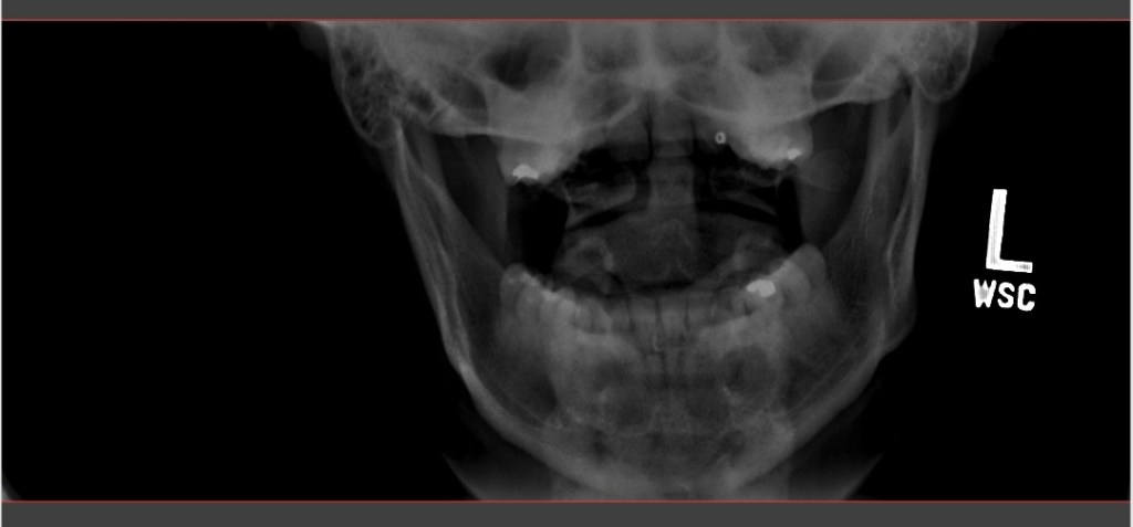 Pain in the Neck - It Could Be Worse Blog - Degenerative Disc Disease - X-ray