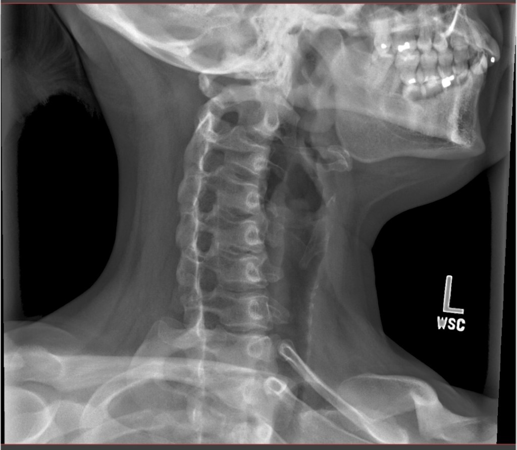 Pain in the Neck - It Could Be Worse Blog - Degenerative Disc Disease - X-ray
