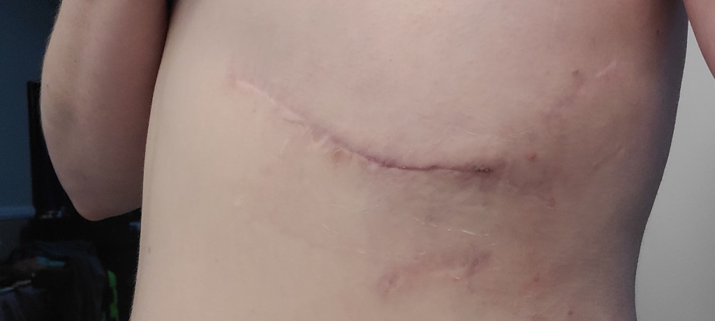 Slipping Rib Syndrome - 3 Months Post-Op and Scheduled for Another Surgery


