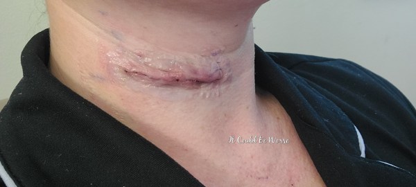 Anterior Cervical Discectomy & Fusion - ACDF Surgery & Recovery - Mary Horsley - It Could Be Worse Blog